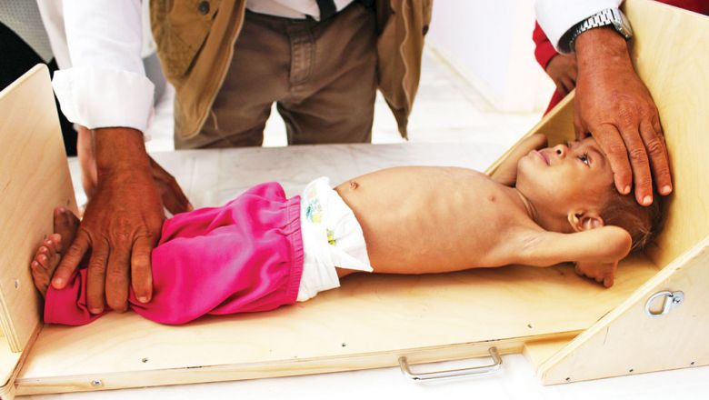 A Yemeni child suffering from severe malnutrition is measured in a hospital in Yemen’s northwestern Hajjah province. ESSA AHMED/afp